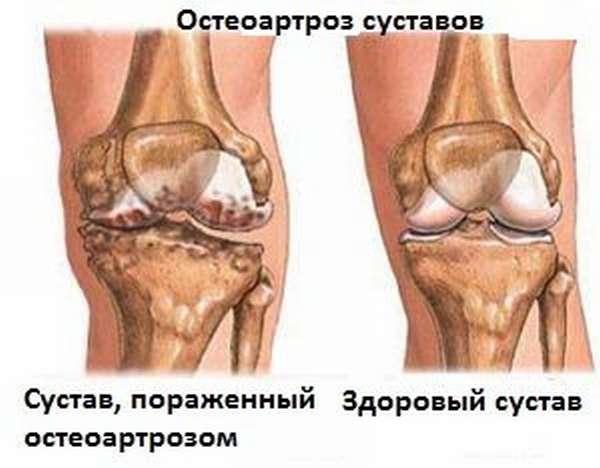 Воспаление колена